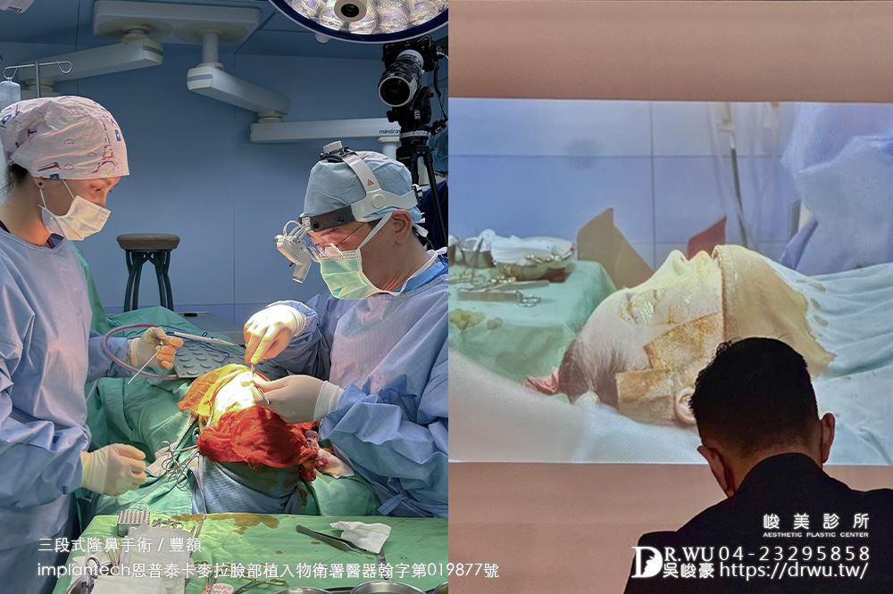 吳峻豪醫生，異體真皮+卡麥拉，隆鼻示範手術，在台北！