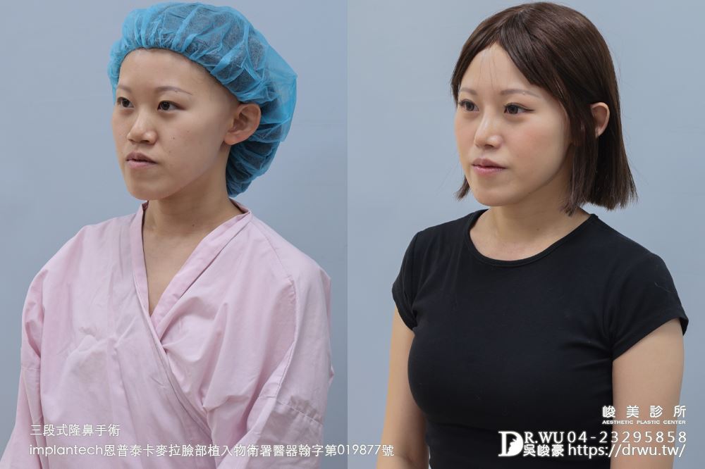 【 三段式隆鼻】 精緻挺鼻，弱化月亮臉型! ｜卡麥拉臉部植入物｜台中隆鼻｜隆鼻手術｜