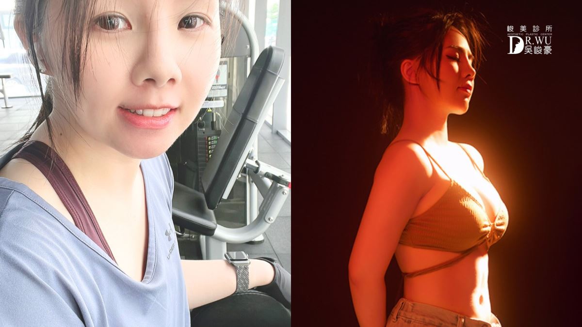 案例三、觀望三年以上，終於決定隆乳的她進行女王波隆乳