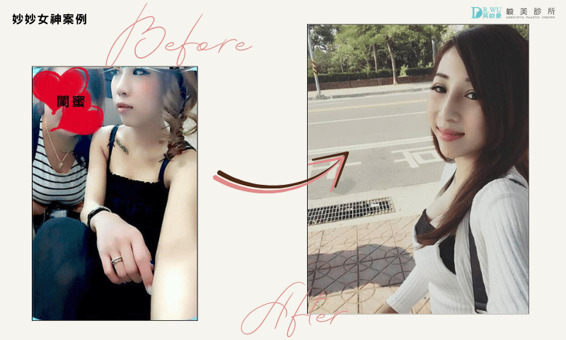 圖片來源：峻美內視鏡輔助隆乳｜妙妙女神案例