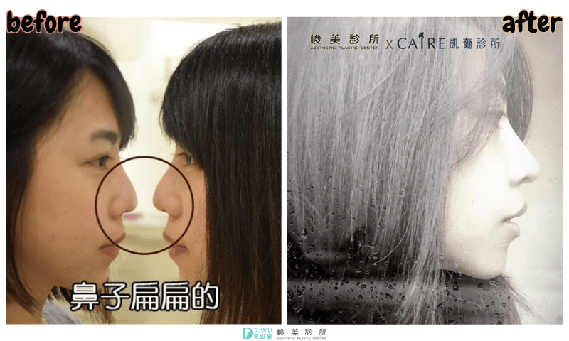 ＂隆鼻＂紫祺祺女神案例