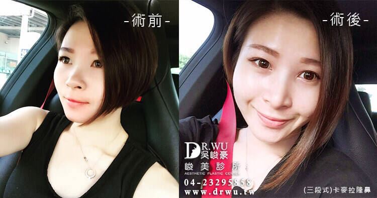 想看完整案例請點擊：＂隆鼻＂粘兒女神案例