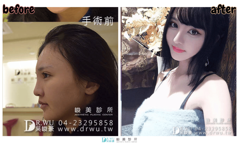 ＂隆鼻＂香香女神案例