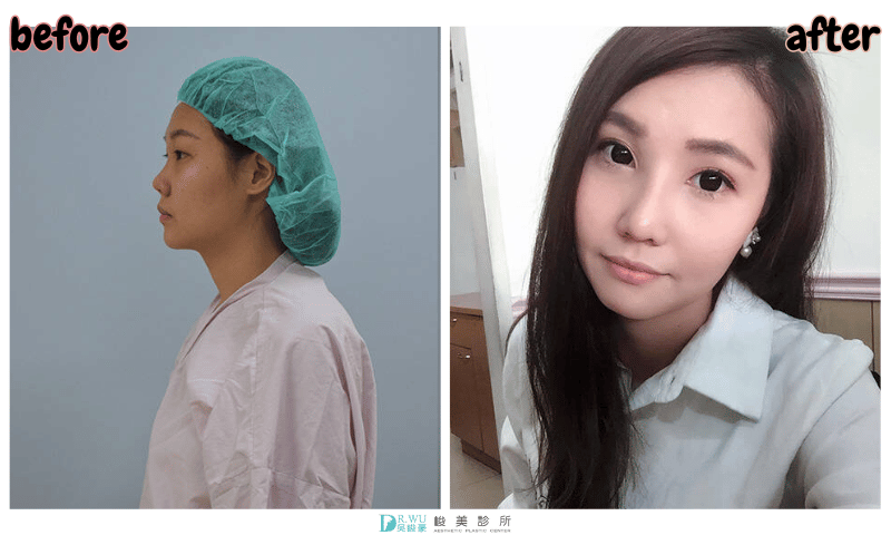 ＂隆鼻＂綺綺女神案例