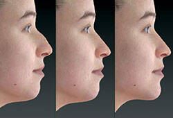 Vectra 3D模擬影像系統模擬鼻型