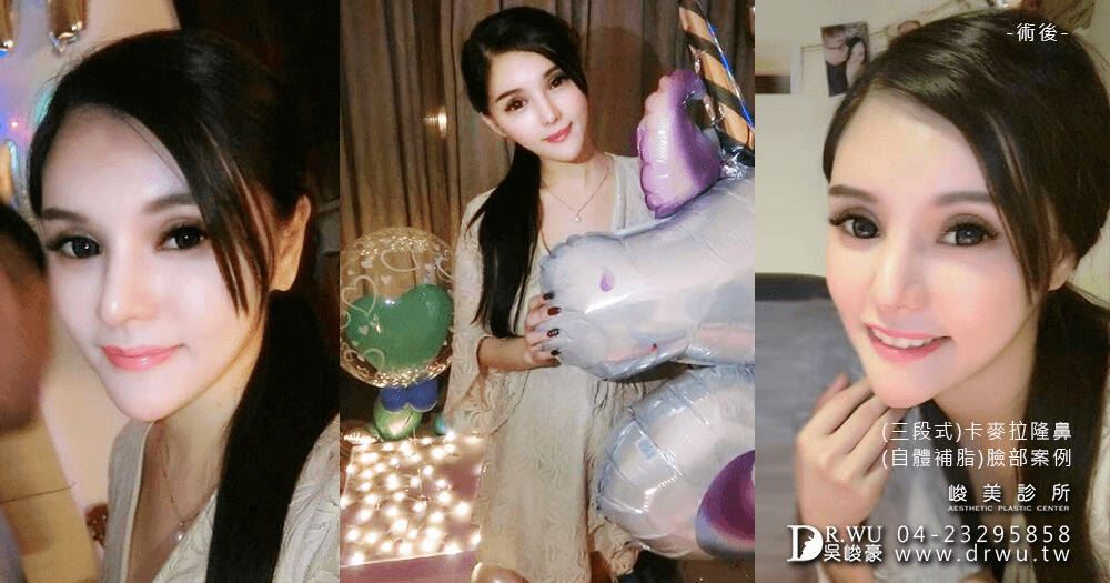 隆鼻手術：＂隆鼻+臉部補脂＂唐莫瑞 女神案例
