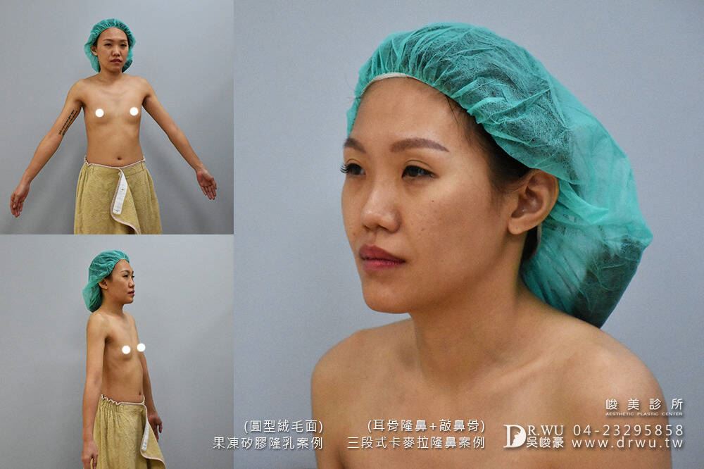 隆鼻手術：＂隆乳＋隆鼻＂Ｍei女神案例
