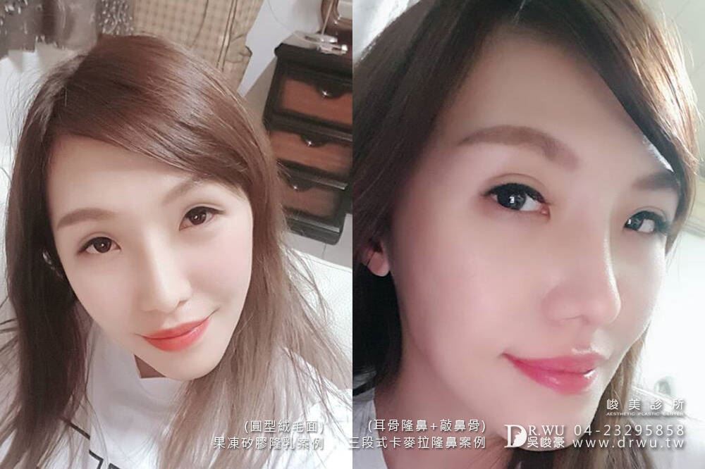 隆鼻手術：＂隆乳＋隆鼻＂Ｍei女神案例