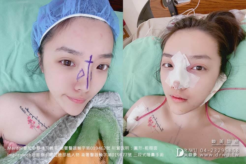 隆鼻手術：＂隆乳+隆鼻＂于臻女神案例