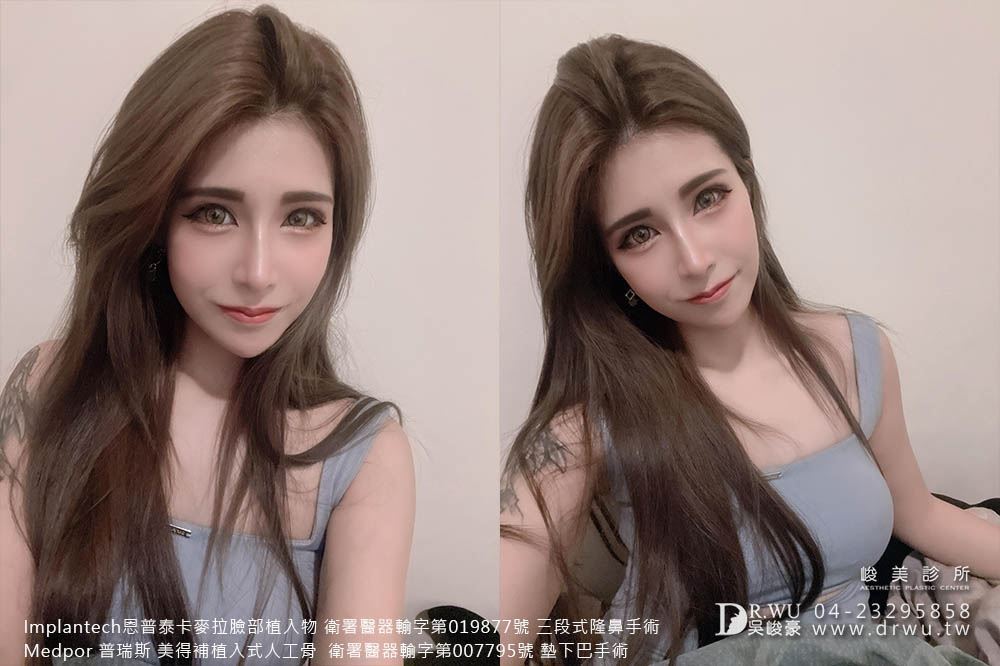 隆鼻手術：＂隆鼻+墊下巴＂FiFi女神案例