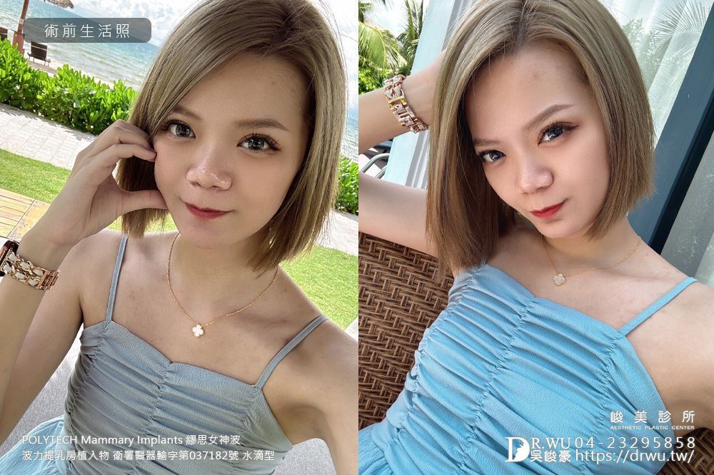 ＂隆乳＂珠珠女神案例-女神波