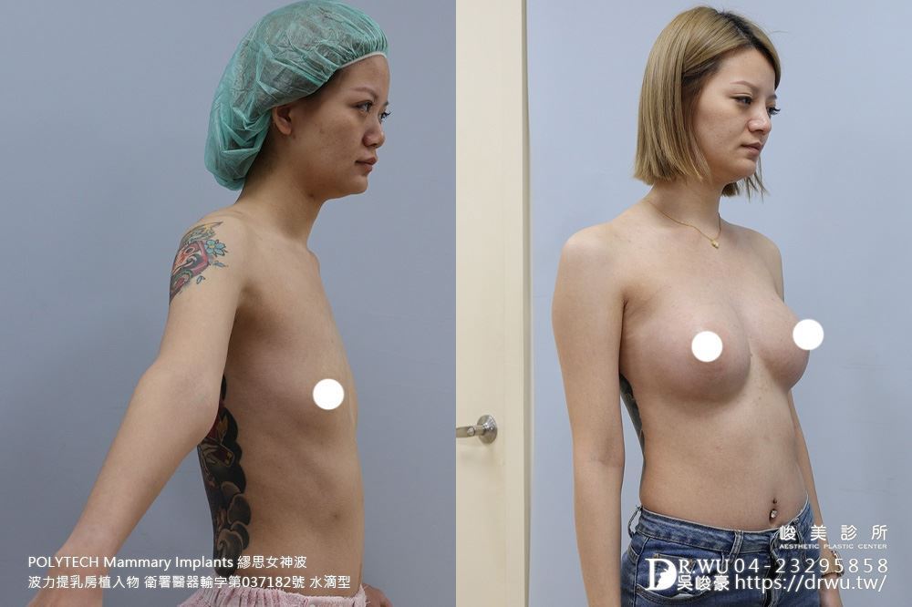 ＂隆乳＂珠珠女神案例-女神波