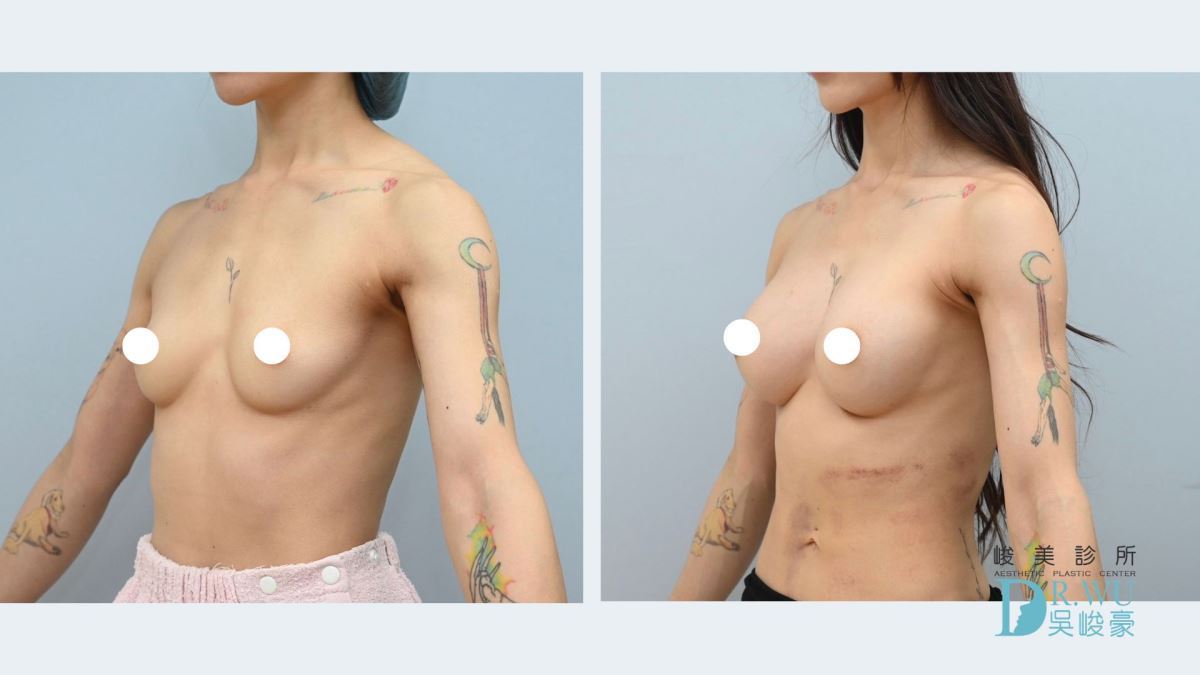 ＂隆乳＂小米女神案例-女神波隆乳