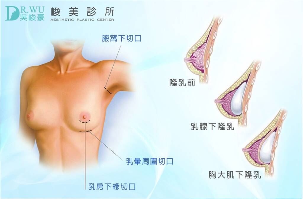 峻美診所隆乳位置判斷圖