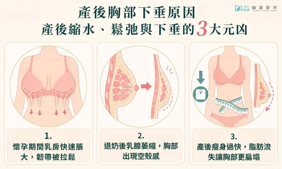 產後胸部下垂原因圖解:懷孕韌帶拉鬆、退奶乳腺萎縮與產後瘦身脂肪流失