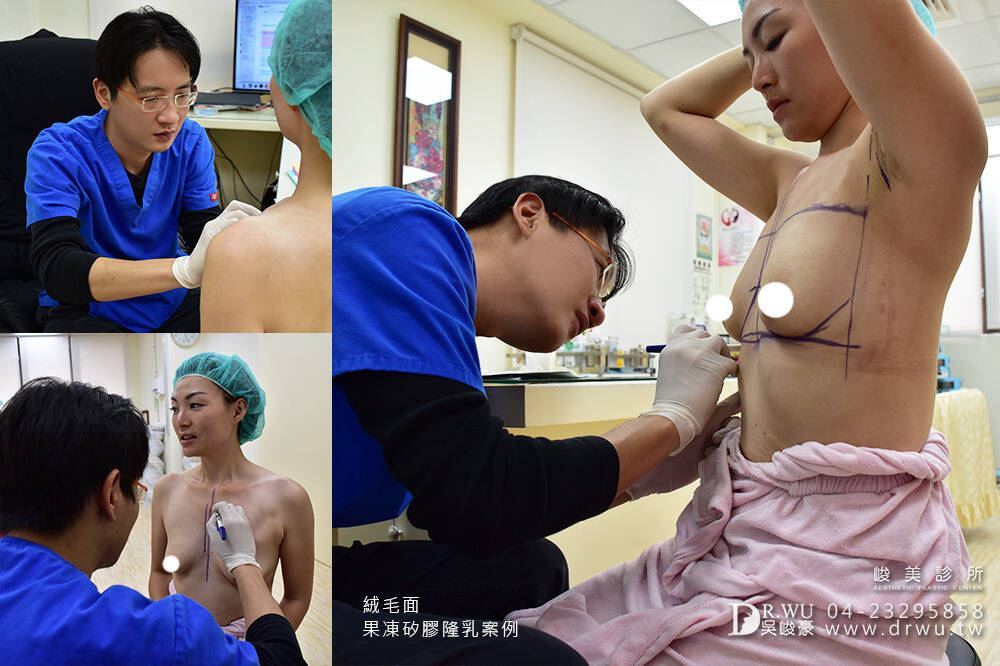 產後胸部變形隆乳案例:Claire透過絨毛面果凍矽膠改善產後縮水