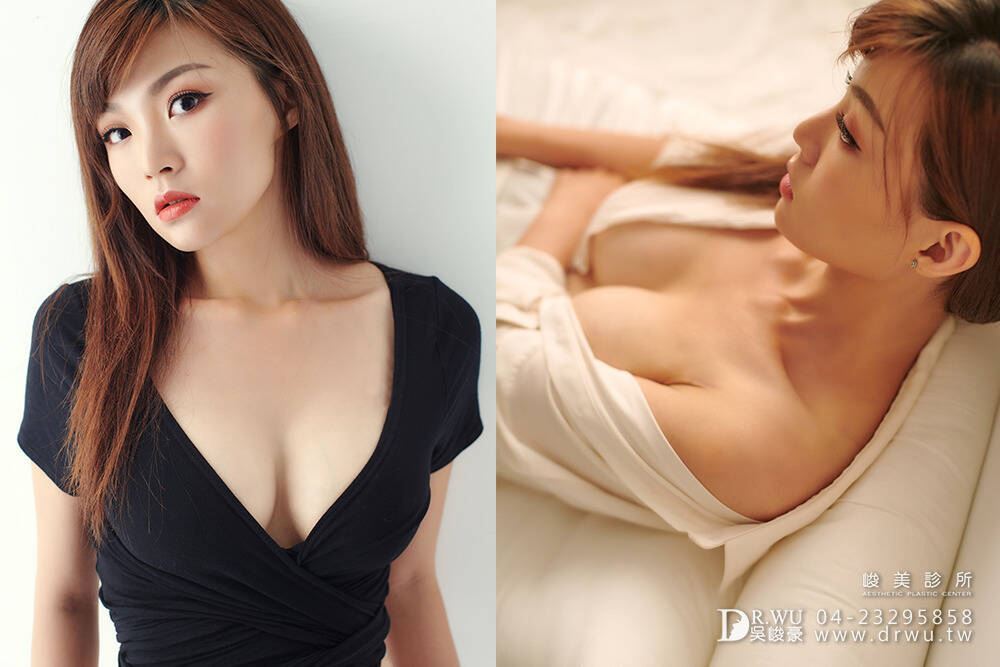 產後隆乳台中推薦案例:Claire術後恢復飽滿立體胸型,穿衣更有曲線