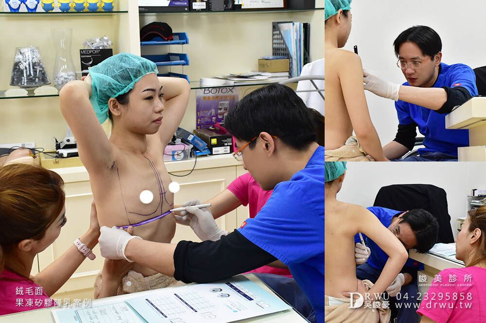 產後下垂隆乳案例:晶晶植入絨毛面果凍矽膠,改善產後胸部平坦