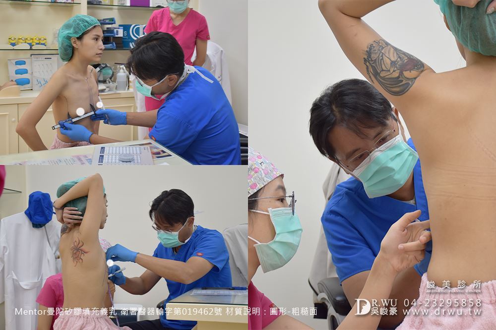 產後退奶縮胸重建:FiFi選用曼陀圓形絨毛面隆乳填補空腔