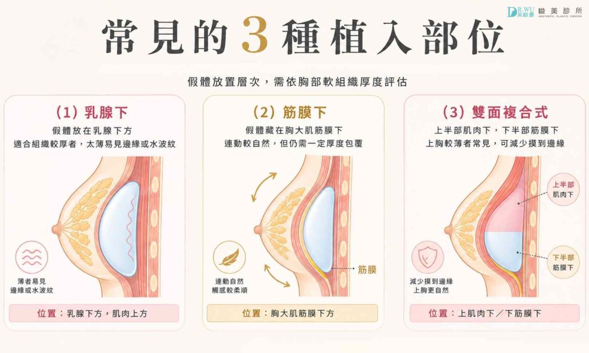 產後隆乳假體植入部位圖解:乳腺下、筋膜下與雙面複合式比較