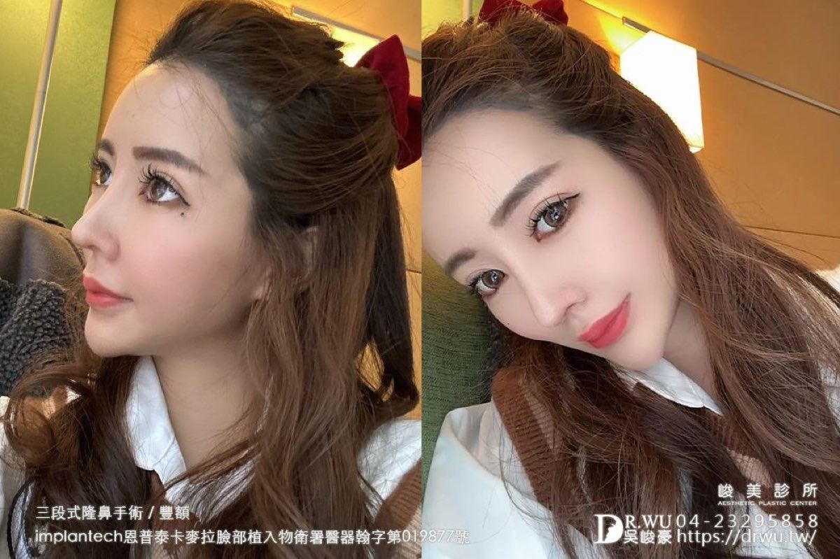 隆鼻重修｜三段式隆鼻術後鼻型