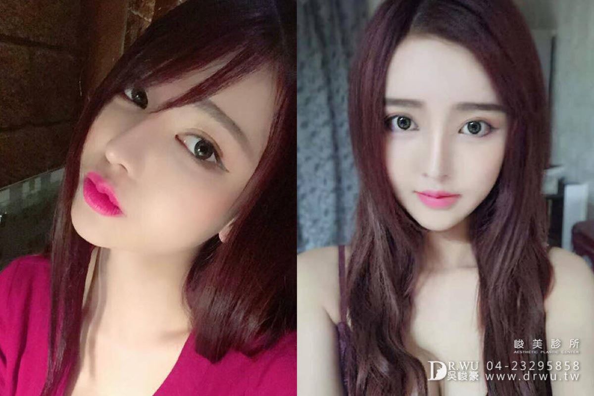 隆鼻重修案例｜香香三段式隆鼻術後
