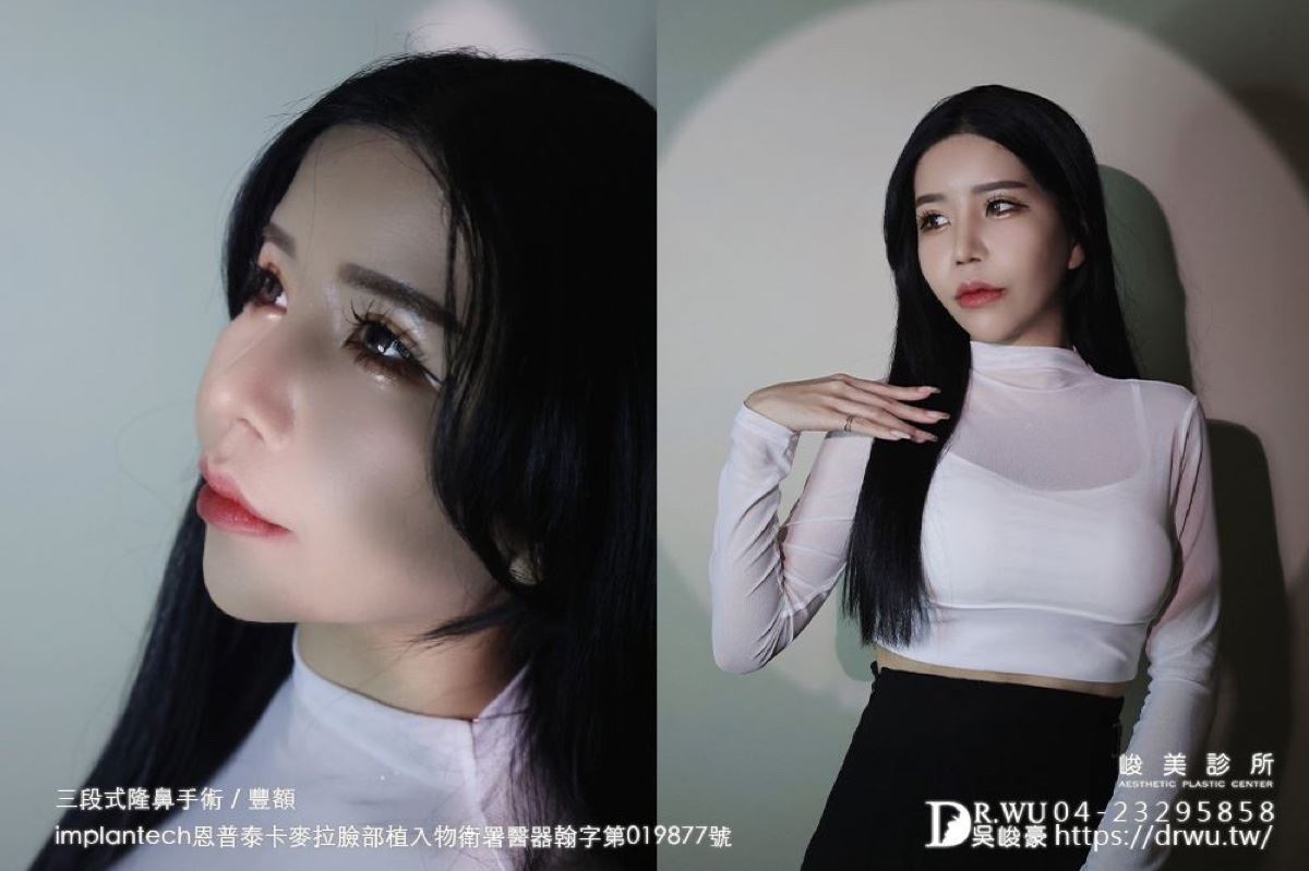 隆鼻重修案例｜瑜瑜術後側顏線條