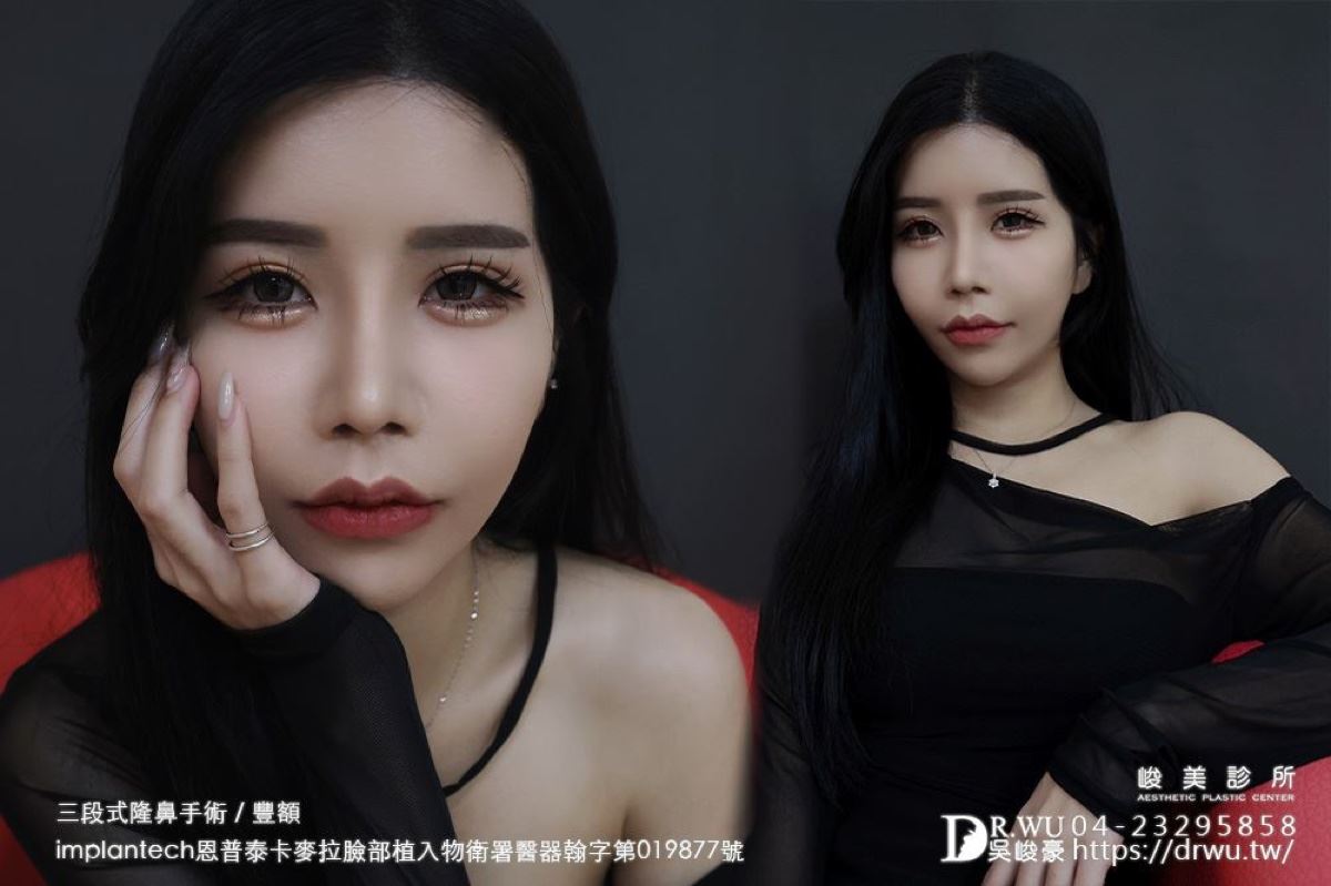 隆鼻重修術後成果｜自體肋軟骨三段式隆鼻