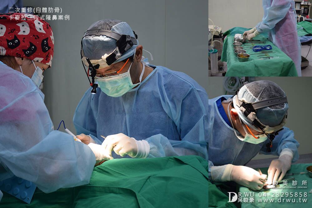 隆鼻重修手術｜吳峻豪醫師執行自體肋骨卡麥拉三段式隆鼻