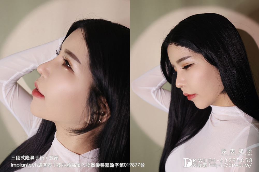 隆鼻重修後的側臉鼻型線條