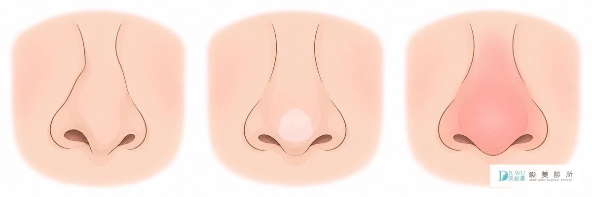 鼻型歪斜、鼻尖皮膚泛白與鼻部泛紅腫脹的外觀差異對照