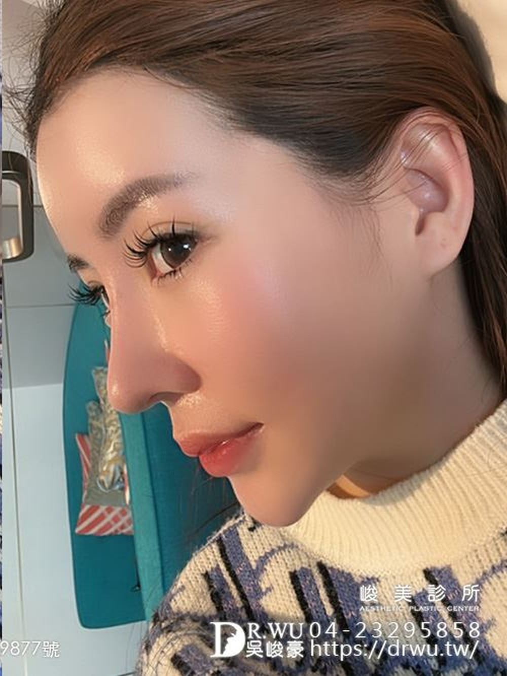 其其隆鼻重修之後的生活照
