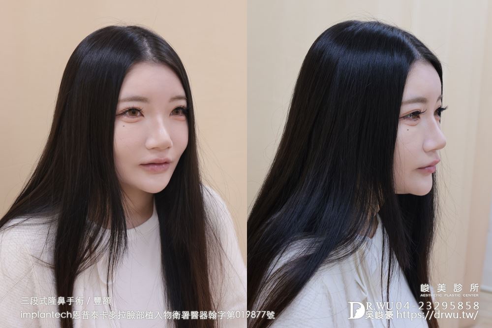 【豐額+隆鼻】 肉鼻頭改善，打造微翹肋骨網美鼻！ ｜卡麥拉臉部植入物｜自體肋骨隆鼻｜台中隆鼻｜吳峻豪醫生｜