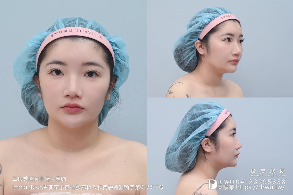 【豐額+隆鼻】 肉鼻頭改善，打造微翹肋骨網美鼻！ ｜卡麥拉臉部植入物｜自體肋骨隆鼻｜台中隆鼻｜吳峻豪醫生｜