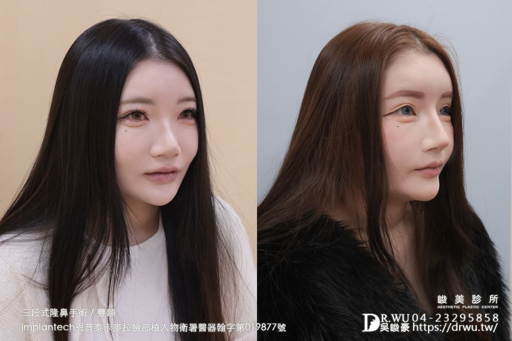 【豐額+隆鼻】 肉鼻頭改善，打造微翹肋骨網美鼻！ ｜卡麥拉臉部植入物｜自體肋骨隆鼻｜台中隆鼻｜吳峻豪醫生｜