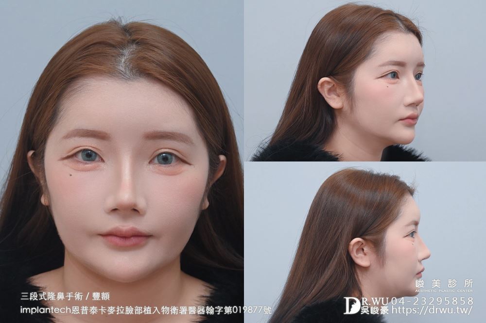 【豐額+隆鼻】 肉鼻頭改善，打造微翹肋骨網美鼻！ ｜卡麥拉臉部植入物｜自體肋骨隆鼻｜台中隆鼻｜吳峻豪醫生｜
