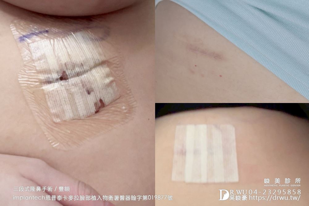 【豐額+隆鼻】 肉鼻頭改善，打造微翹肋骨網美鼻！ ｜卡麥拉臉部植入物｜自體肋骨隆鼻｜台中隆鼻｜吳峻豪醫生｜