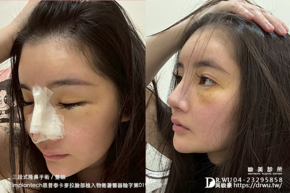 【豐額+隆鼻】 肉鼻頭改善，打造微翹肋骨網美鼻！ ｜卡麥拉臉部植入物｜自體肋骨隆鼻｜台中隆鼻｜吳峻豪醫生｜