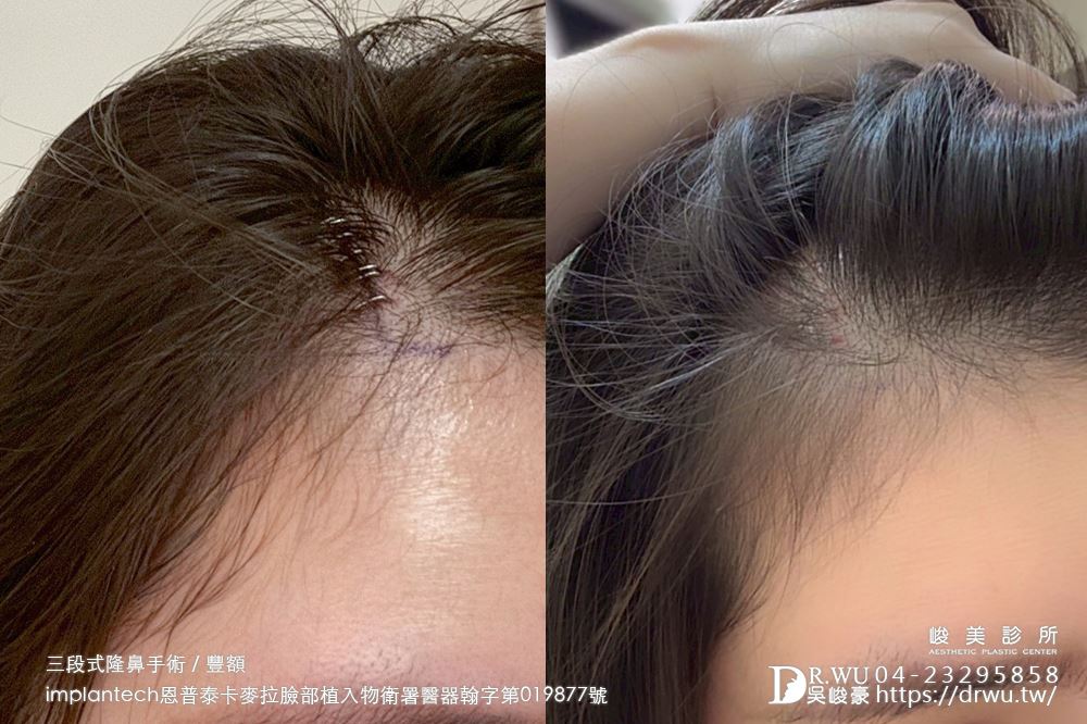 【豐額+隆鼻】 肉鼻頭改善，打造微翹肋骨網美鼻！ ｜卡麥拉臉部植入物｜自體肋骨隆鼻｜台中隆鼻｜吳峻豪醫生｜