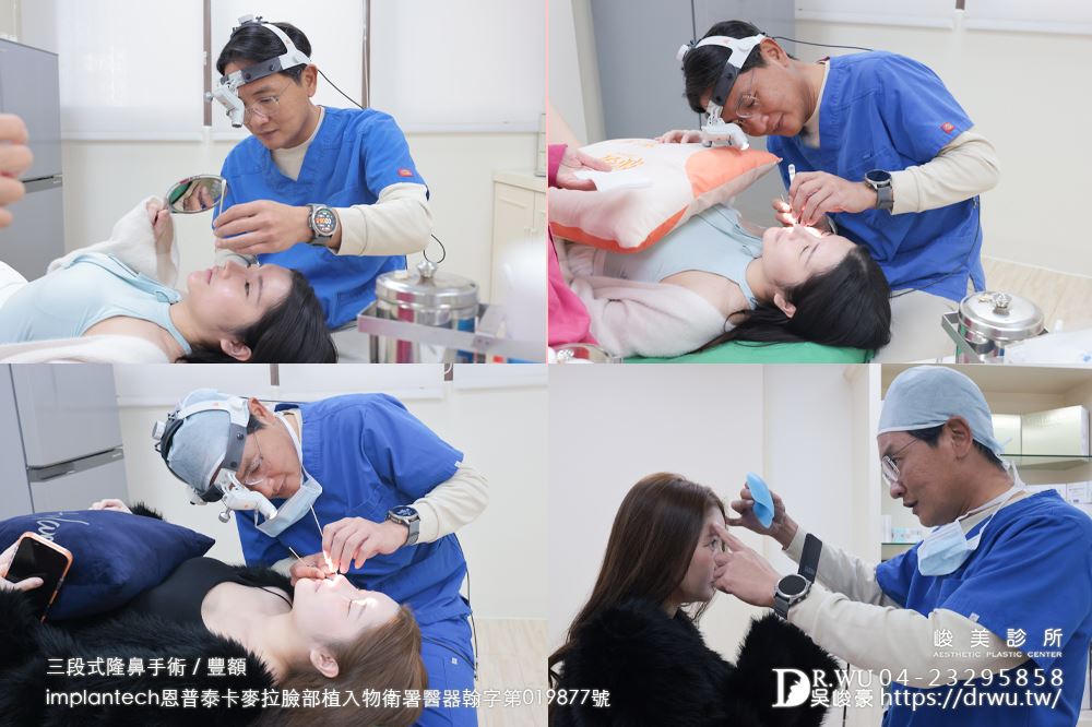 【豐額+隆鼻】 肉鼻頭改善，打造微翹肋骨網美鼻！ ｜卡麥拉臉部植入物｜自體肋骨隆鼻｜台中隆鼻｜吳峻豪醫生｜