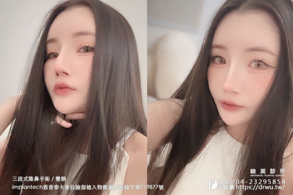 【豐額+隆鼻】 肉鼻頭改善，打造微翹肋骨網美鼻！ ｜卡麥拉臉部植入物｜自體肋骨隆鼻｜台中隆鼻｜吳峻豪醫生｜