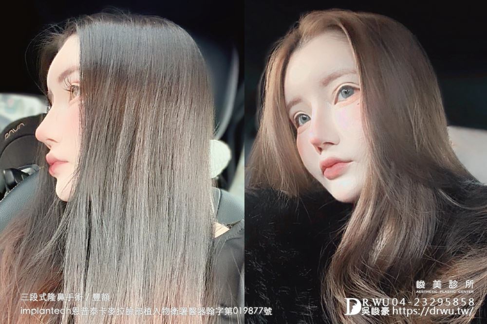 【豐額+隆鼻】 肉鼻頭改善，打造微翹肋骨網美鼻！ ｜卡麥拉臉部植入物｜自體肋骨隆鼻｜台中隆鼻｜吳峻豪醫生｜