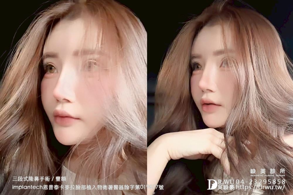 【豐額+隆鼻】 肉鼻頭改善，打造微翹肋骨網美鼻！ ｜卡麥拉臉部植入物｜自體肋骨隆鼻｜台中隆鼻｜吳峻豪醫生｜
