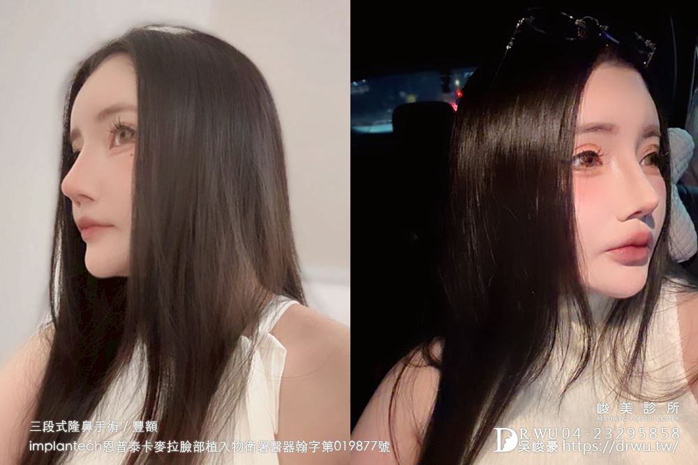 【豐額+隆鼻】 肉鼻頭改善，打造微翹肋骨網美鼻！ ｜卡麥拉臉部植入物｜自體肋骨隆鼻｜台中隆鼻｜吳峻豪醫生｜