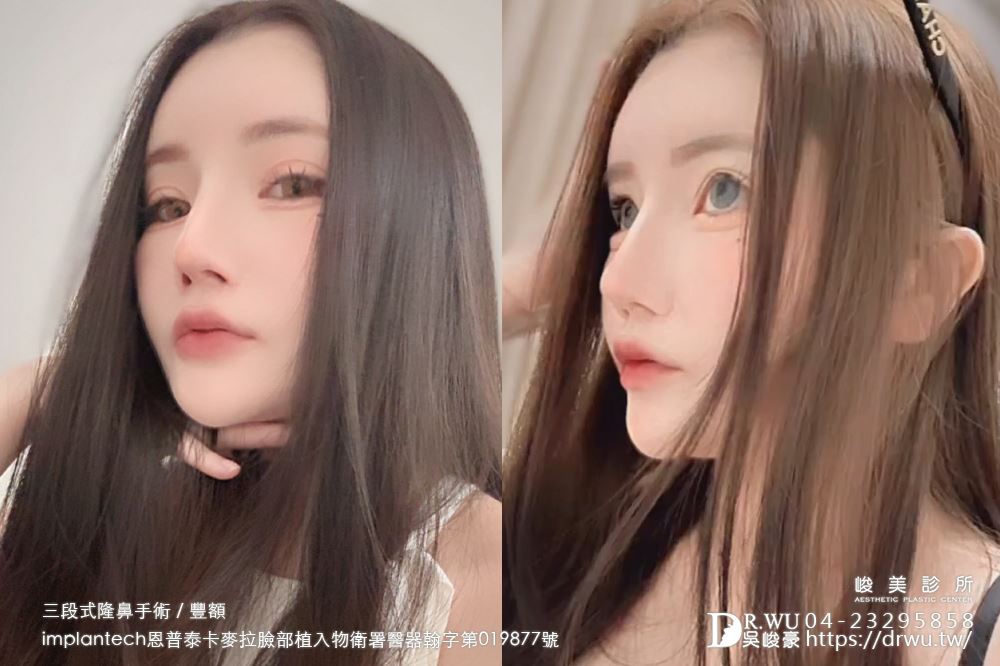 【豐額+隆鼻】 肉鼻頭改善，打造微翹肋骨網美鼻！ ｜卡麥拉臉部植入物｜自體肋骨隆鼻｜台中隆鼻｜吳峻豪醫生｜