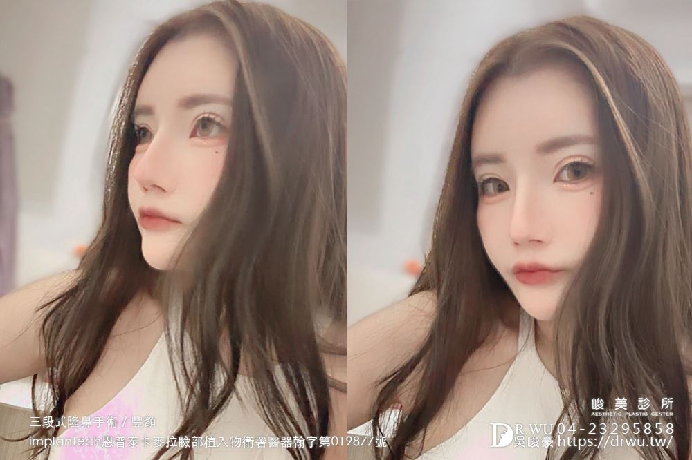 【豐額+隆鼻】 肉鼻頭改善，打造微翹肋骨網美鼻！ ｜卡麥拉臉部植入物｜自體肋骨隆鼻｜台中隆鼻｜吳峻豪醫生｜
