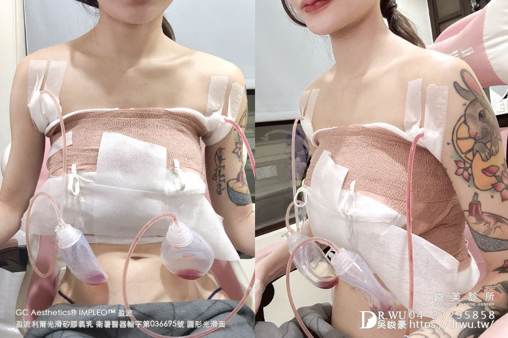『盈波隆乳』 纖瘦女孩隆乳重修，打造飽滿芭比身材! ｜免按摩隆乳｜光滑面隆乳｜隆乳重修｜