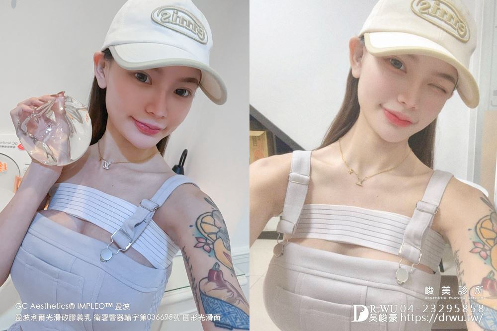 『盈波隆乳』 纖瘦女孩隆乳重修，打造飽滿芭比身材! ｜免按摩隆乳｜光滑面隆乳｜隆乳重修｜