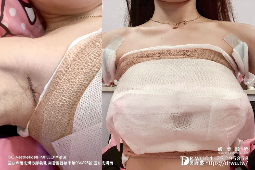 『盈波隆乳』 纖瘦女孩隆乳重修，打造飽滿芭比身材! ｜免按摩隆乳｜光滑面隆乳｜隆乳重修｜
