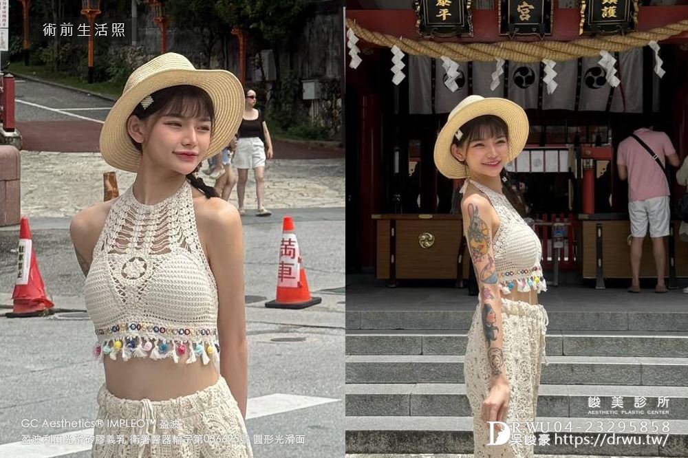 『盈波隆乳』 纖瘦女孩隆乳重修，打造飽滿芭比身材! ｜免按摩隆乳｜光滑面隆乳｜隆乳重修｜